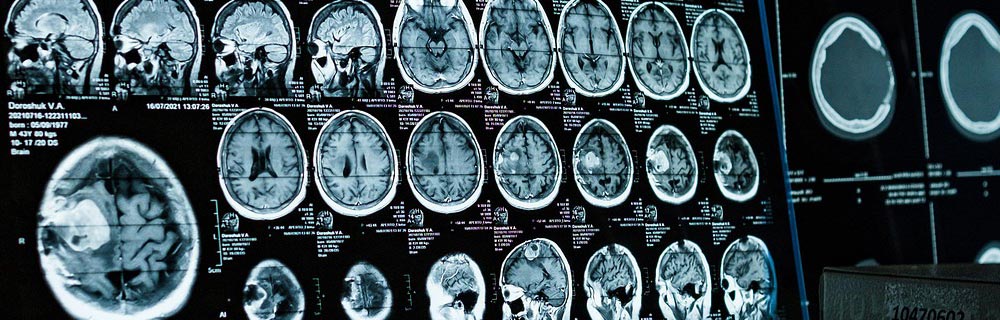 head brain injury claims